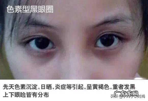 17岁高中生熬夜有眼袋,黑眼圈,泪沟,怎么办