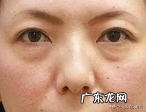 17岁高中生熬夜有眼袋,黑眼圈,泪沟,怎么办