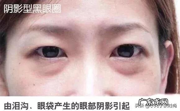 17岁高中生熬夜有眼袋,黑眼圈,泪沟,怎么办