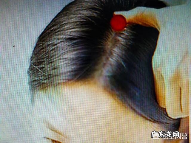 自己面瘫针灸后为什么流泪较多?