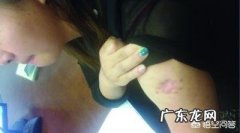 用针灸和拔罐减肥有效吗？