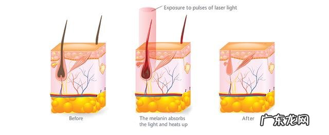 脱毛几次能彻底干净 脱毛一般多久干净