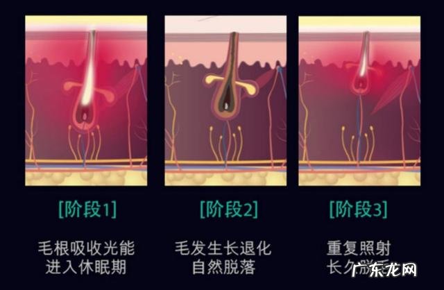 什么脱毛最彻底 脱毛最好选什么