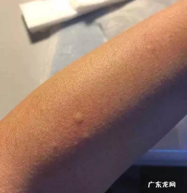 驴皮脱毛最佳的方法 到底什么样的脱毛方法才比较靠谱