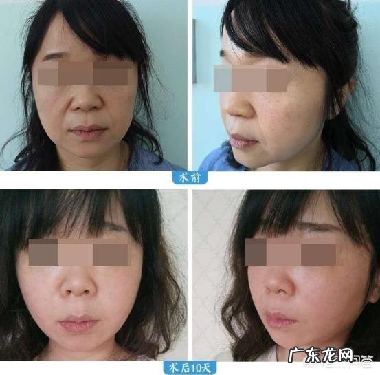 法令纹到底有多显老?如何预防法令纹?