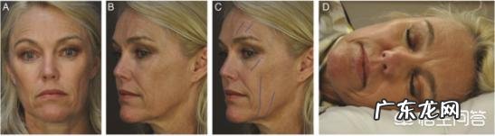 法令纹到底有多显老?如何预防法令纹?