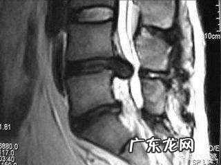 椎间盘突出压迫神经可以自然恢复吗?可以的话,需要多长时间?