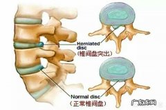 椎间盘突出压迫神经可以自然恢复吗？可以的话，需要多长时间？