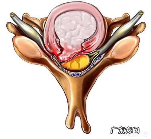 有什么方法能立刻解决坐骨神经痛呢?