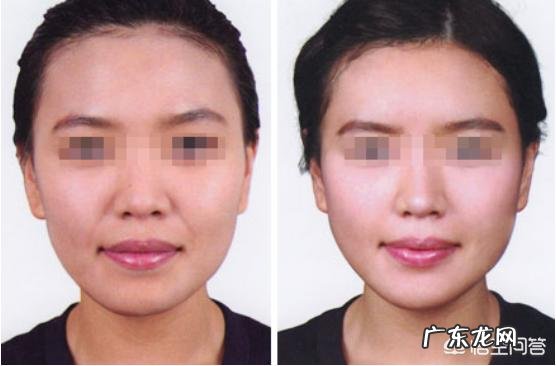 如何通过医美手段祛法令纹?