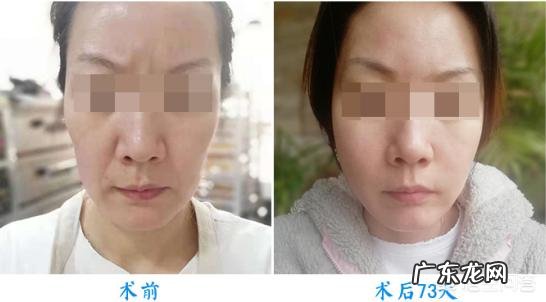 如何通过医美手段祛法令纹?