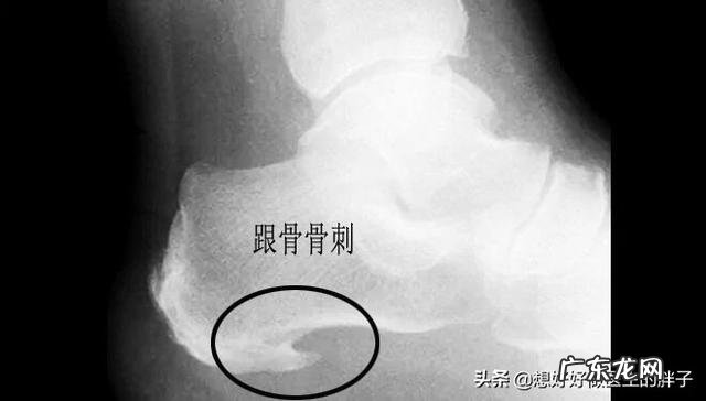 身高160体重135斤,想在6个月内瘦到100斤,该怎么减肥