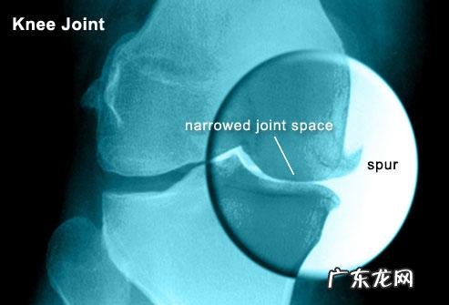 更年期会造成关节疼吗?更年期过后就不疼了吗?