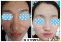 皮肤屏障受损，油痘皮，怎么修复？