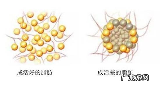法令纹到底能不能用自体脂肪填充? 自体脂肪填充法令纹亲身经历