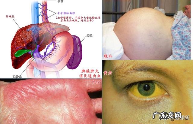 肝变“硬”了,还能扭转吗