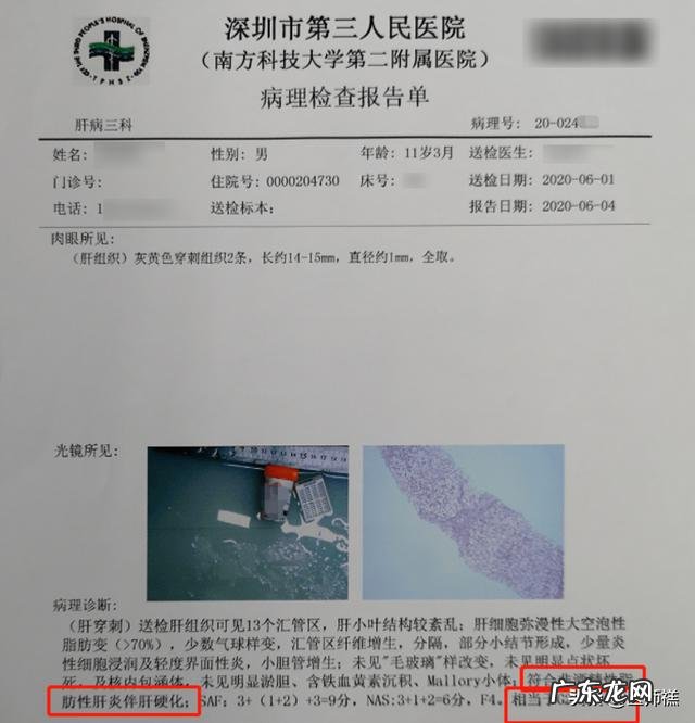 肝变“硬”了,还能扭转吗