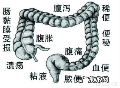 慢性结肠炎的症状是肚脐眼疼吗?