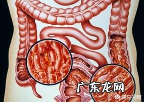慢性结肠炎的症状是肚脐眼疼吗?