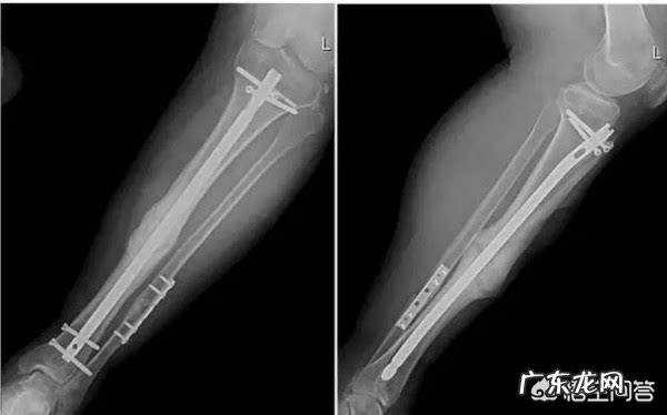 胫腓骨双骨折,髓内钉固定手术后两个月了,是不是要去复查了?