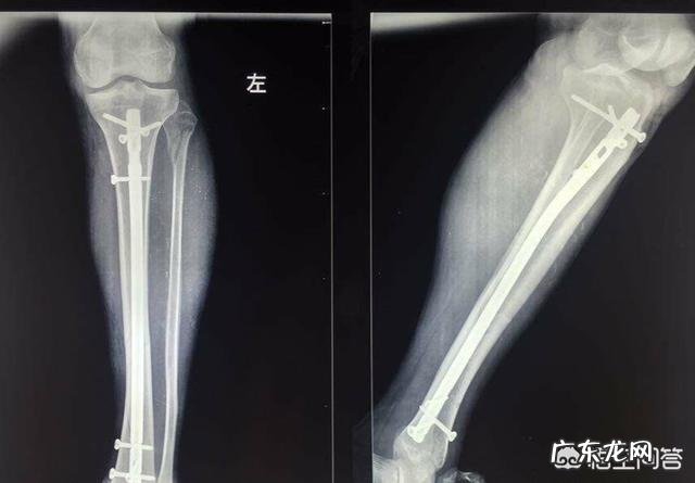 胫腓骨双骨折,髓内钉固定手术后两个月了,是不是要去复查了?