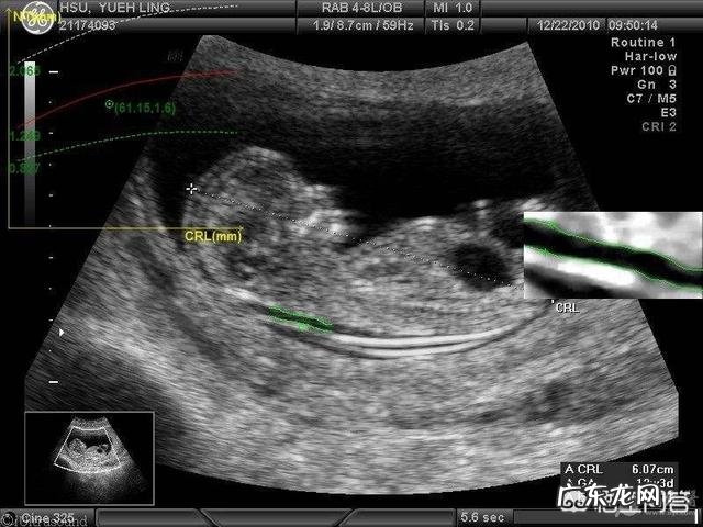 三个月胎儿在肚子里趴着怎么办