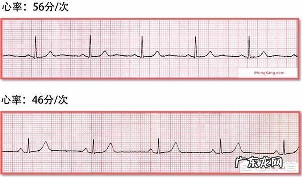 心率过缓的人,适合快走或慢跑吗?