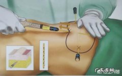 运动不良加速衰老，“减肥妙招”们该如何取舍？