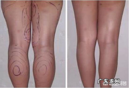 运动不良加速衰老,“减肥妙招”们该如何取舍?