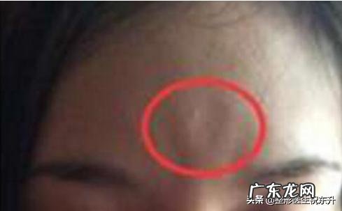 扁平疣的患病原因是什么?