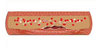38岁体检量血压,发现高压正常,低压高,怎么回事