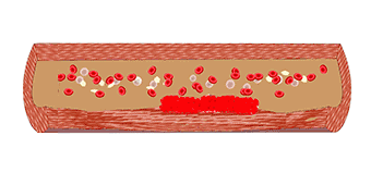 38岁体检量血压,发现高压正常,低压高,怎么回事