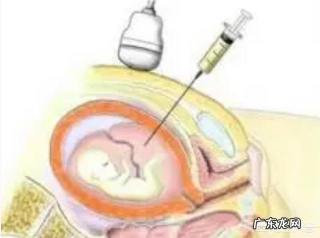 唐氏筛查出临界风险不做无创DNA有危险吗