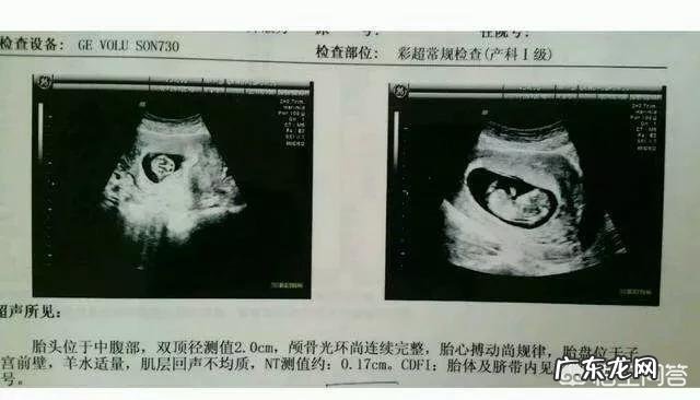 孕早期唐氏综合征筛查指数多少属于正常范围