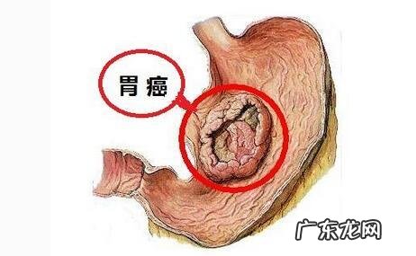 胃炎与胃癌前期症状有什么异同点,胃炎长期不zhi会变胃癌吗?