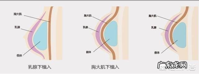 A罩杯的人,怎样才能快速丰胸呢?有哪些方法呢?