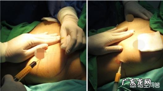 A罩杯的人,怎样才能快速丰胸呢?有哪些方法呢?