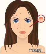 请问长痘痘的时候要少吃什么