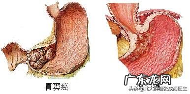 胃癌复发吃不下呕吐能活多久?