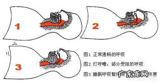 打鼾都会伴有睡眠呼吸暂停吗?