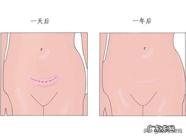 剖腹产妈妈要想产后排气快需要怎么做?在饮食上需要注意什么?