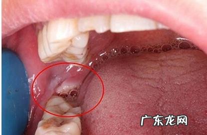 智齿什么时候拔最合适拔智齿有哪些利与弊