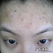 脸上冒痘还长斑，说是肝毒太多，怎么排肝毒？