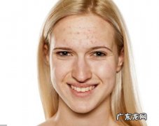 不吃高糖，不吃油炸，饮食清淡，为什么还会长痘？