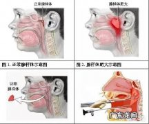 四岁宝宝腺样体肥大，怎么办？全职妈妈心里急？