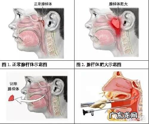 四岁宝宝腺样体肥大,怎么办?全职妈妈心里急?