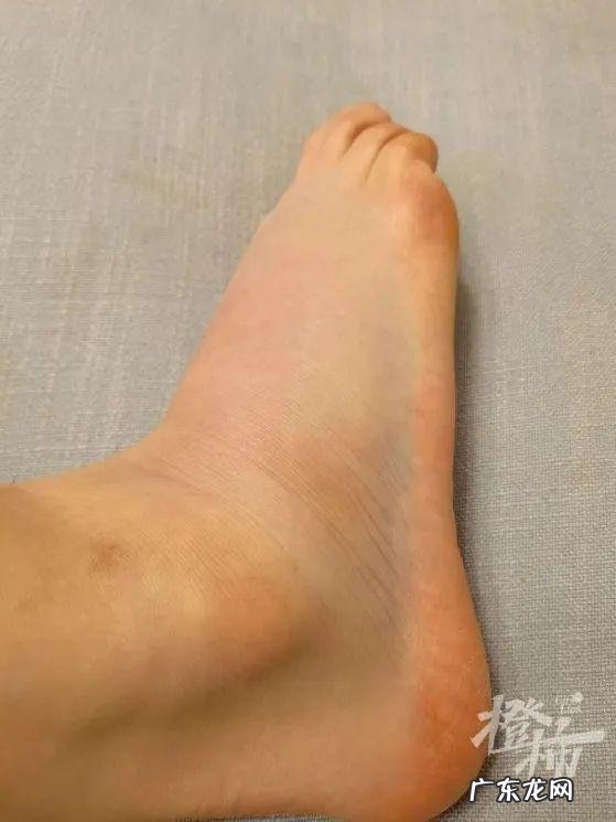 毽子操是不是伤膝盖 刘畊宏的毽子操对膝盖友好么