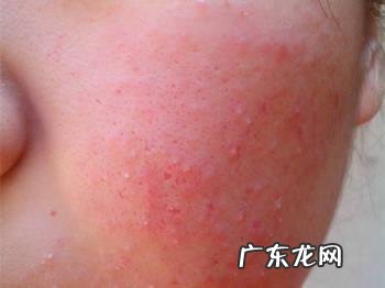 洗脸过敏怎么办 洗脸过敏如何处理