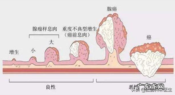 如果每年都做肠镜,发现息肉就处理,是不是得结肠癌的可能不大?