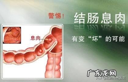 如果每年都做肠镜,发现息肉就处理,是不是得结肠癌的可能不大?